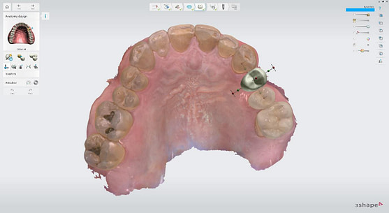 Virtual crown design before implant planning 2