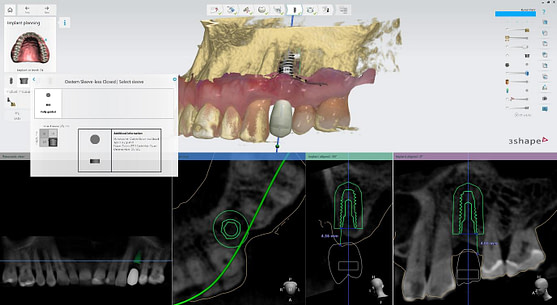 implant libray selection