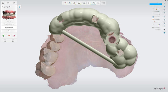 surgical guide support bar 2