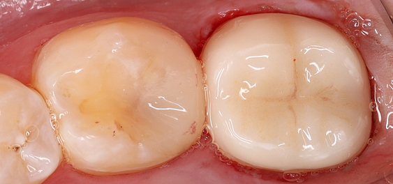 13 - Medit Innovation Day 2023 Presentation Single-Visit Restorations Using Medit ClinicCAD Ahmad Al-Hassiny - Slide13