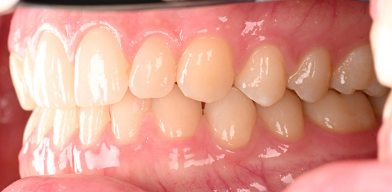 3shape-intraoral-trios-scan-bite-splint-idd-institute-of-digital-dentistry-blog-byron-park-patient-buccal-bite-view-quadrant-2-3
