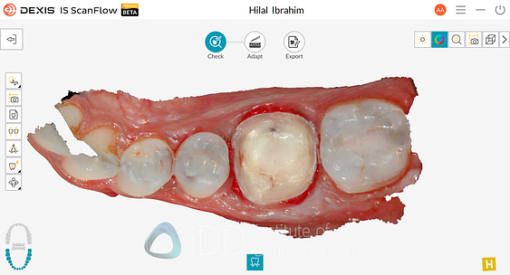 dexis_3800_wireless_intraoral_scanner_review_institute_of_Digital_dentistry34