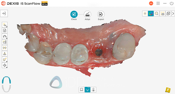 dexis_3800_wireless_intraoral_scanner_review_institute_of_Digital_dentistry6