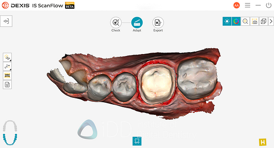 dexis_3800_wireless_intraoral_scanner_review_institute_of_Digital_dentistry33