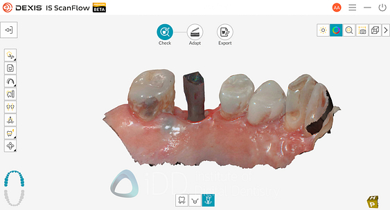 dexis_3800_wireless_intraoral_scanner_review_institute_of_Digital_dentistry5