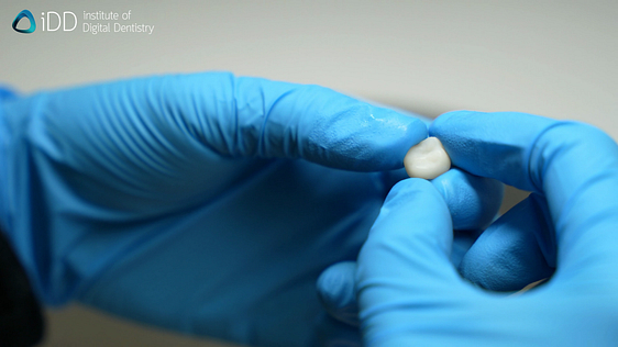 idd-3d-printing-dental-crowns-finished-3d-printed-crown