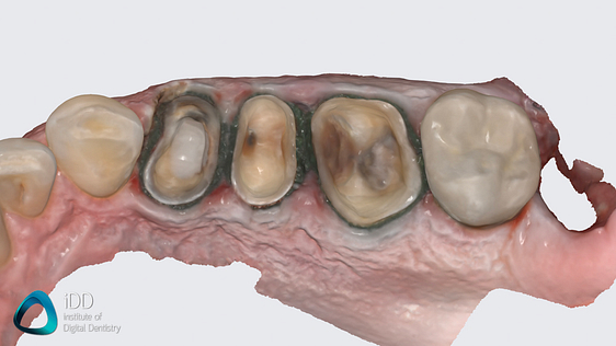 medit_i900_review_scanner_software_IDD (1)