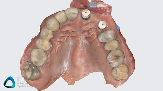 medit_i900_review_scanner_software_IDD (2)
