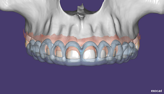 Surgical crown lengthening guide