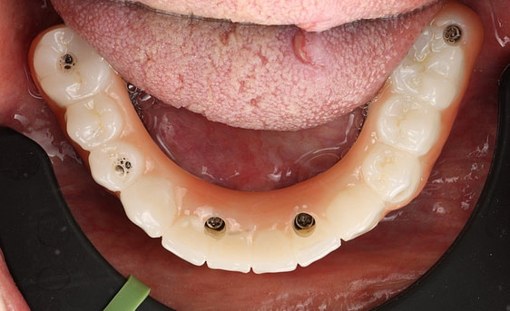 Fig.10+Final+Prosthesis+Lower+Zirconia+Insert