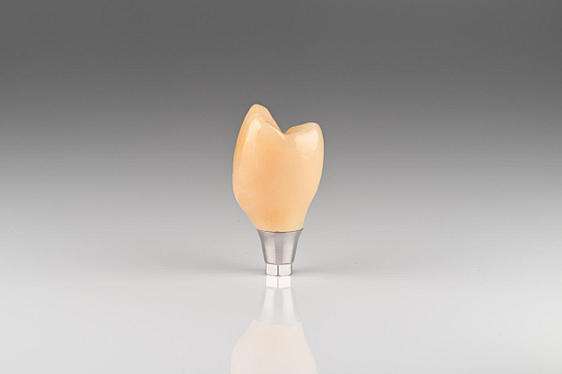 Crown is milled, sintered, stained, glazed, and cemented to the Ti base