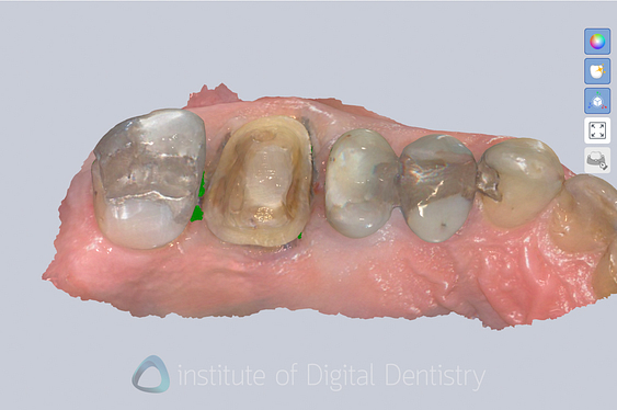 alliedstar_sensa_intraoral_scanner_review_iDD (9)