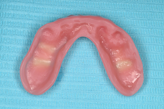 rodin-soft-reline-kit-3d-printed-dentures-workflow-blog-idd-institute-of-digital-dentistry-lower-denture-bevel-border-intaglio-surface