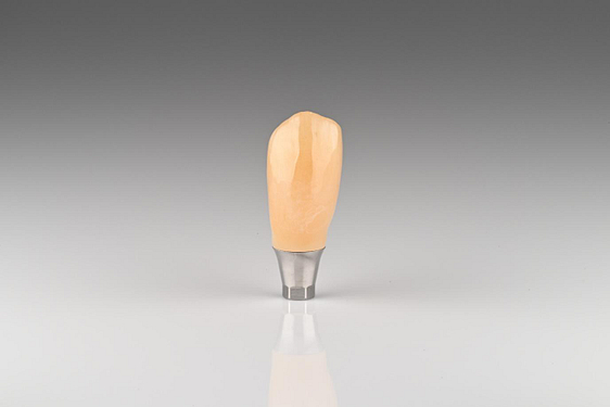 Crown is milled, sintered, stained, glazed, and cemented to the Ti base 2