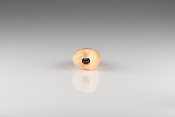 Crown is milled, sintered, stained, glazed, and cemented to the Ti base 4