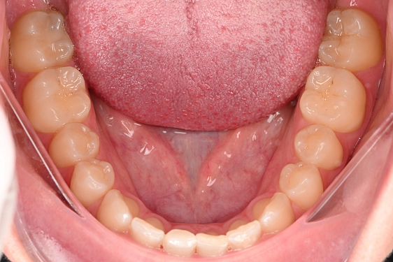 3shape-intraoral-trios-scan-bite-splint-idd-institute-of-digital-dentistry-blog-byron-park-patient-lingual-view