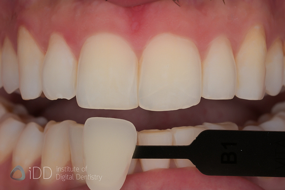 borea_cobra_shade_matching_dentistry_Dental Spectrophotometers and Shade-Matching_iDD4