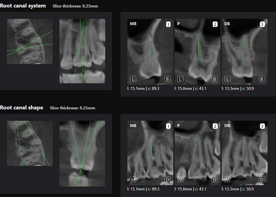 Root canal shapes