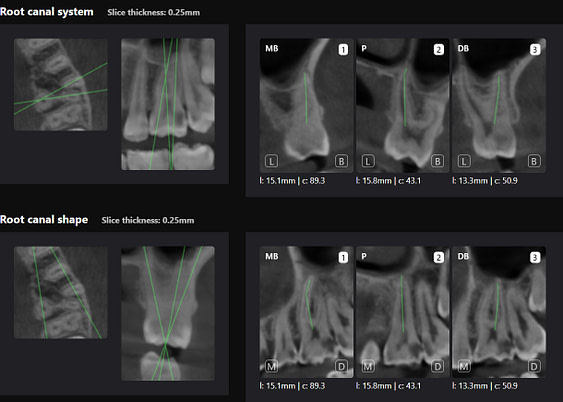 Root canal shapes