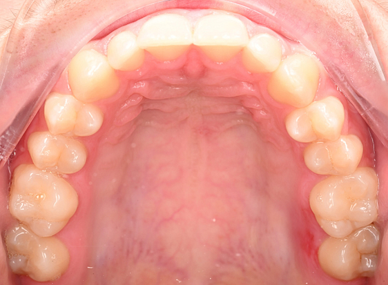 3shape-intraoral-trios-scan-bite-splint-idd-institute-of-digital-dentistry-blog-byron-park-patient-palatal-view