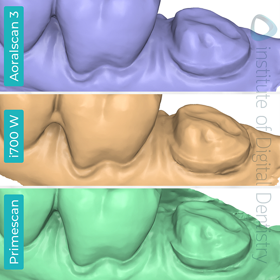 idd-compares-shining-3d-dental-aoralscan-3-medit-i700w-dentsply-sirona-cerec-primescan-intraoral-scanner-medit-design-stl-file-buccal-margin-prep-line