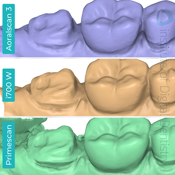 idd-compares-shining-3d-dental-aoralscan-3-medit-i700w-dentsply-sirona-cerec-primescan-intraoral-scanner-medit-design-stl-file-lingual-margin-prep-line