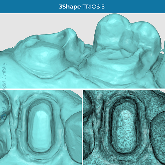 idd-compares-3shape-trios5-intraoral-scanner-scan-margin-prep-tessellated-mesh-zoom-scans