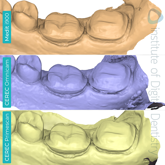 medit-i900-cerec-omnicam-cerec-primescan-dentsply-sirona-idd-compares-institute-of-digital-dentistry-blog-medit-design-software-app-prep-margin-line-lingual-view