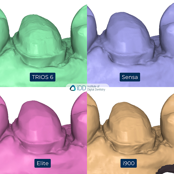 5-3Shape-TRIOS-6-Alliedstar-Sensa-Shining-3D-Aoralscan-Elite-Medit-i900-intraoral-scanner-ios-idd-compares-upper-stl-scan-buccal-margin-prep-view