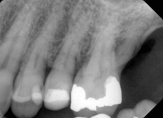 Root canal treatment on tooth 46 was completed, and a crown placed