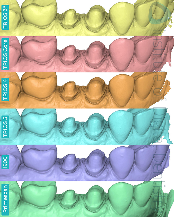 3shape-trios-3-updated-4-5-core-medit-i900-dentsply-sirona-cerec-primescan-intraoral-scanner-institute-of-digital-dentistry-idd-compares-blog-medit-design-app-stl-file-format-margin-prep-line-buccal-view
