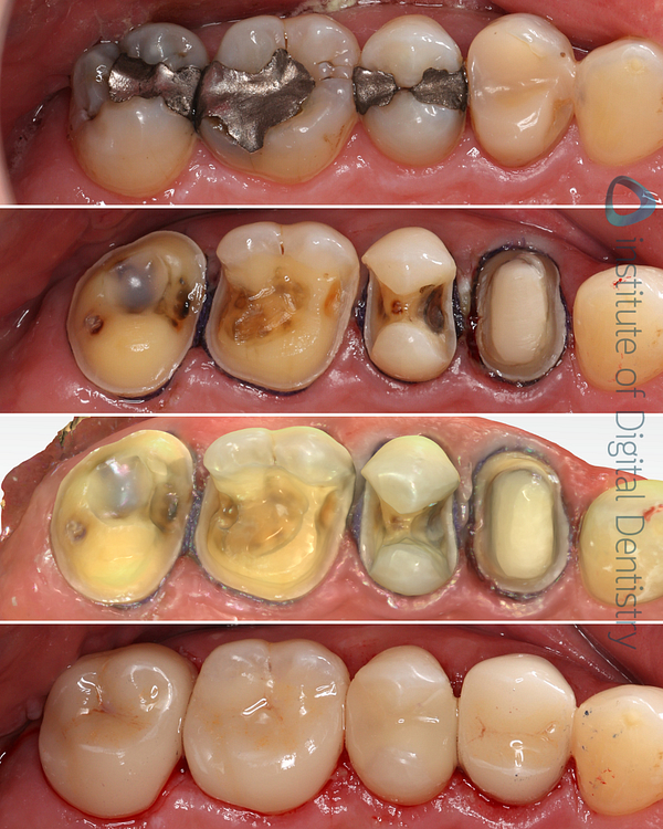 idd-compares-alliedstar-as200e-shining-3d-aoralscan3-dentsply-sirona-cerec-primescan-runyes-3ds-3-3shape-trios5-intraoral-scanner-before-after-prep-scan