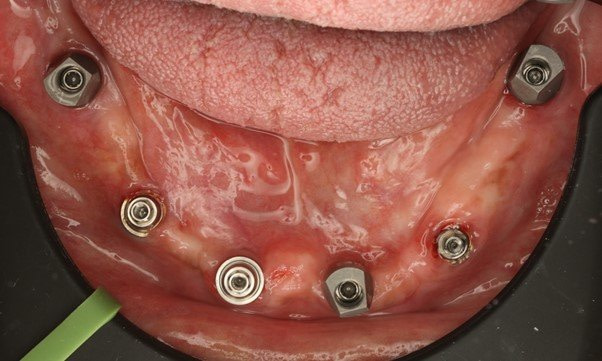 The Nexus IOS Workflow - Restoring Full Arch Implants