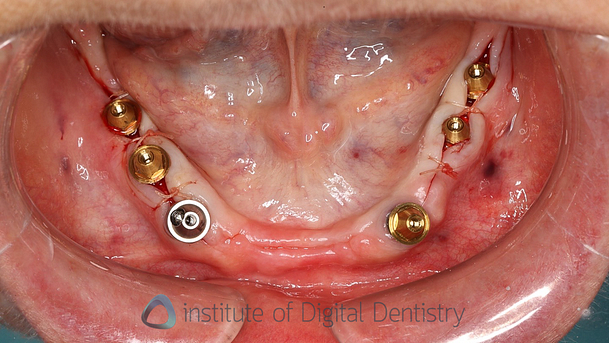 shining_3D_aoralscan_elite_review_institute_of_digital_dentistry10