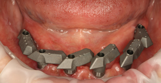 Fig.6+Tissue+and+Multi+Unit+Abutments+-+Scan+Gauges