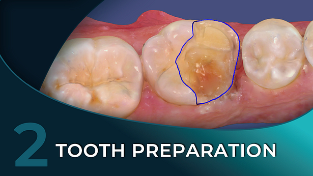 Thumbnail Masterclass v2 tooth prep #