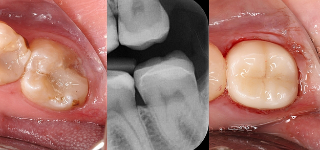 29 - Medit Innovation Day 2023 Presentation Single-Visit Restorations Using Medit ClinicCAD Ahmad Al-Hassiny - Slide29