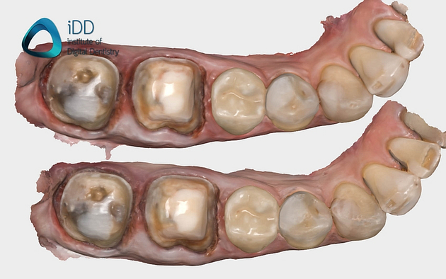 figure-4-medit-hd-mode-vs-non-hd-mode Figure 4. Non-HD (top) and HD (bottom) scans were taken of the same preparation with the Medit i700 Wireless to illustrate the difference when using this mode. As you can see, the HD scan mode clearly results in a higher definition scan.