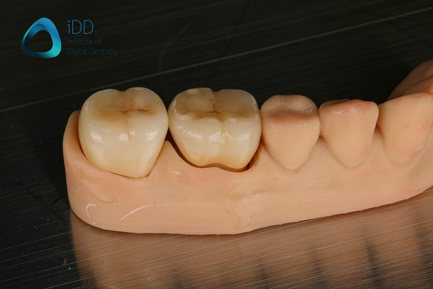 figure-9-e-max-crowns-post-processing-teeth Figure 9. IPS e.max crowns before and after post-processing including ceramic characterisation, glazing and firing.