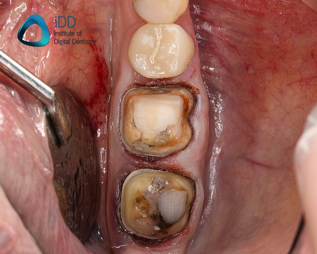 figure-2-completed-tooth-preps-for-two-IPS-e-max-crowns Figure 2. Completed tooth preparations for two IPS e.max ceramic crowns.