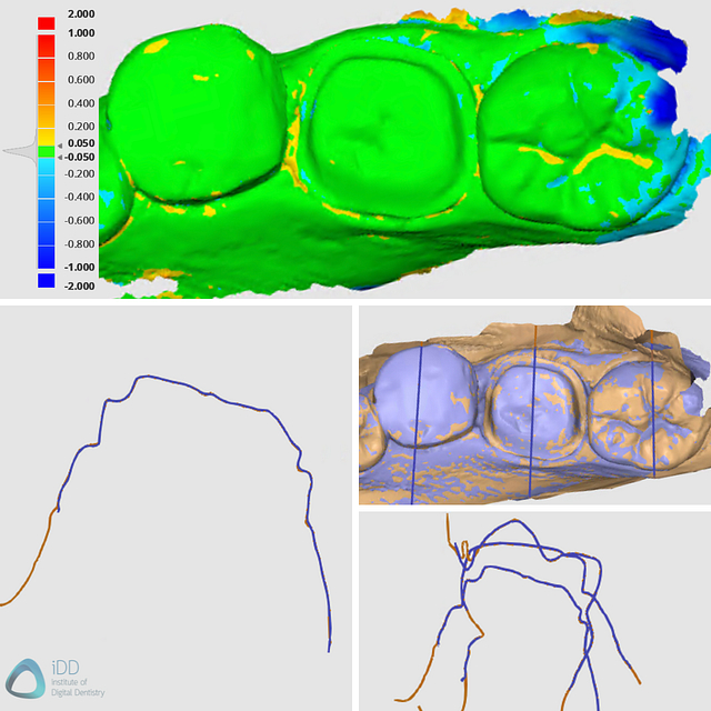 idd-compares-shining-3d-dental-aoralscan-3-dentsply-sirona-cerec-primescan-medit-design-stl-cad-software-alignment-deviation