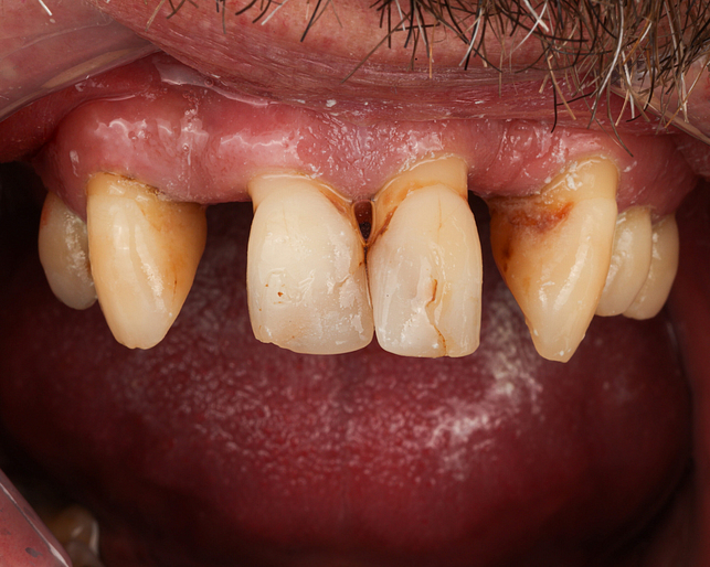 All-on-x before All-on-X Implants