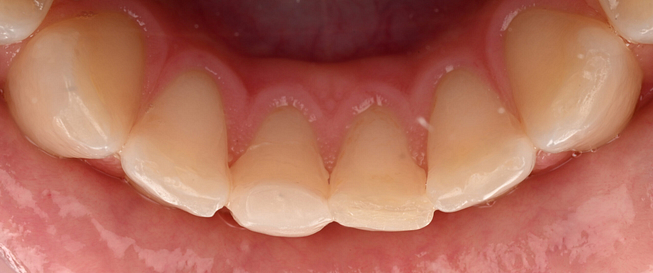 3shape-intraoral-trios-scan-bite-splint-idd-institute-of-digital-dentistry-blog-byron-park-patient-lingual-zoom-incisors