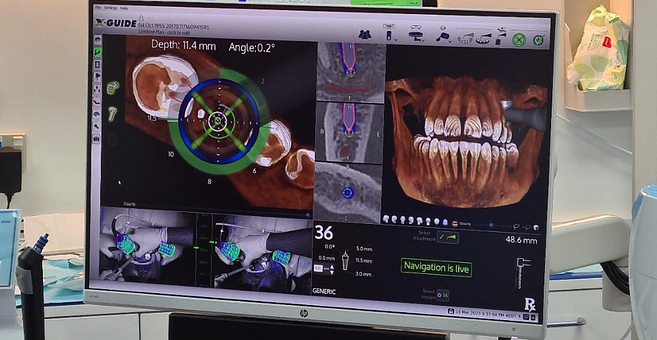 x-guide-implant-software