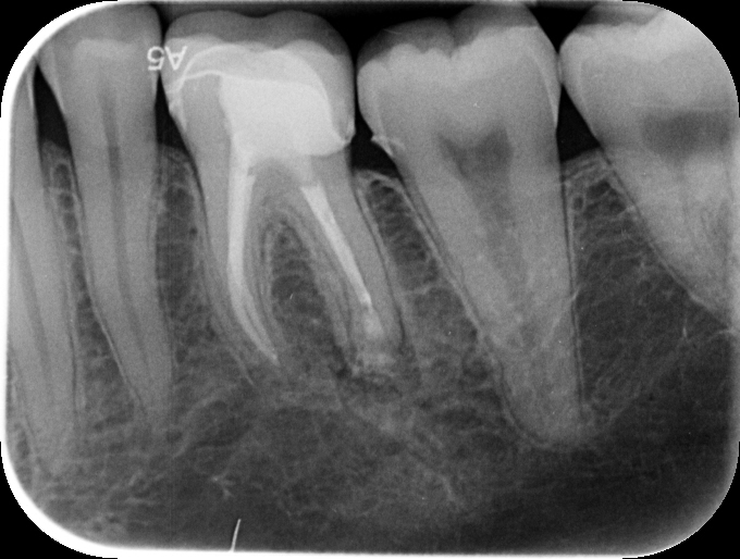 navident-evo-claronav-dynamic-navigation-idd-institute-of-digital-dentistry-dr-byron-park-first-impressions-post-op-pa-scan