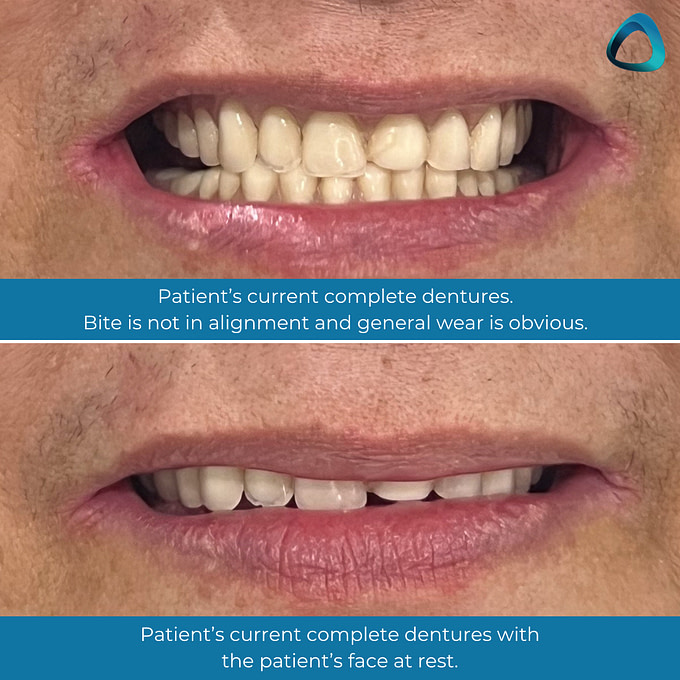 idd-digital-dentures-blog-clinical-case-patient-before-complete-dentures