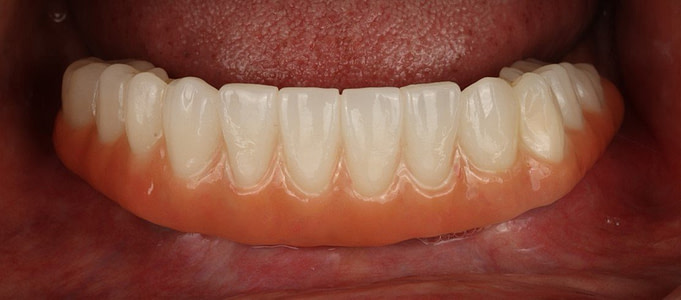 Fig.11+Final+Prosthesis+Lower+Zirconia+Insert