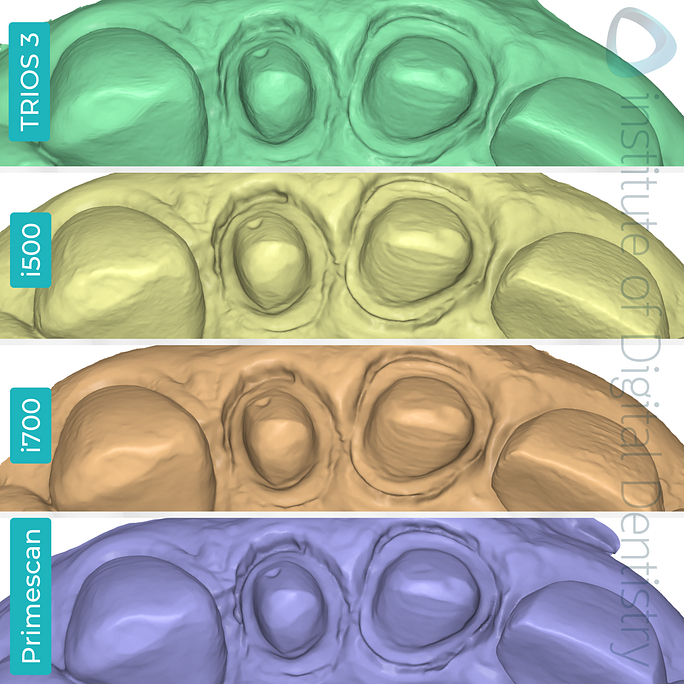idd-compares-intraoral-scanners-3shape-trios3-medit-i500-i700-dentsply-sirona-cerec-primescan-medit-design-software-app-incisal-view-margin-prep.png