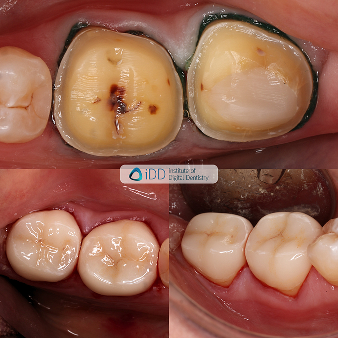 idd-compares-institute-of-digital-dentistry-blog-photo-margin-prep-restoration