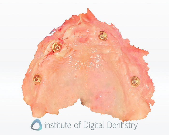 edentulous_intraoral_scanning_iDD1